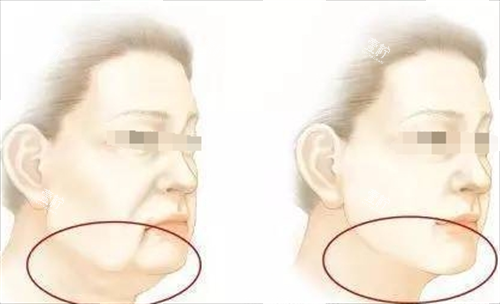 微拉美面部提升动画前后对比图.png
