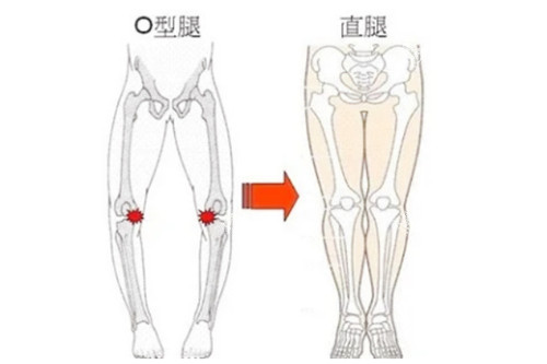 腿型矫正图对比.jpg
