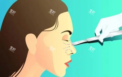 隆鼻失败修复示意图.jpg 隆鼻失败修复示意图.jpg