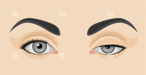 双眼皮修复前后对比.jpg