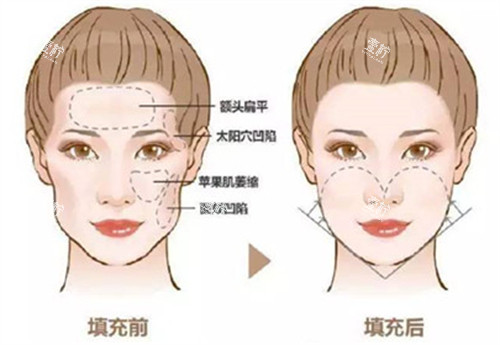 自体脂肪填充前后对比图.jpg 自体脂肪填充前后对比图.jpg