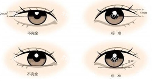双眼皮示意图.JPG