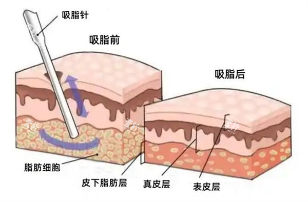 面部吸脂图.jpg