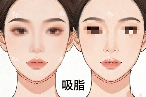 下巴做吸脂前后对比图.jpg 下巴做吸脂前后对比图.jpg