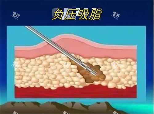 负压吸脂示意图.png 负压吸脂示意图.png