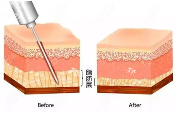 吸脂手术操作.jpg 吸脂手术操作.jpg