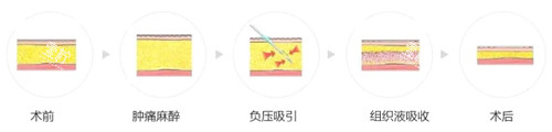 吸脂过程图解.jpg 吸脂过程图解.jpg