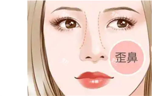歪鼻修复.jpg 歪鼻修复.jpg