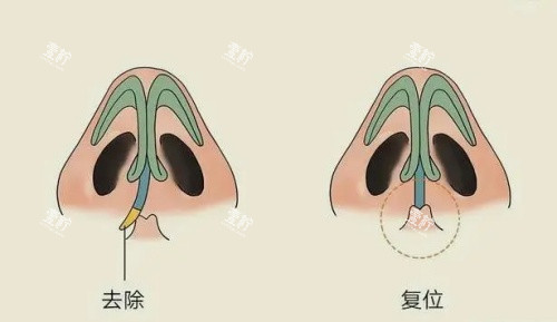 歪鼻修复矫正.jpg 歪鼻修复矫正.jpg