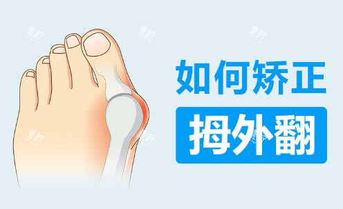 如何矫正拇外翻.jpg 如何矫正拇外翻.jpg