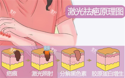 激光祛疤原理示图.jpg