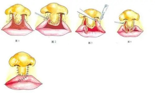 唇裂鼻修复图.jpg