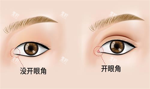 开眼角前后对比图.png