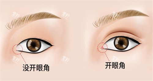 开眼角手术对比.jpg
