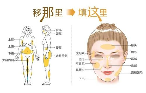 自体脂肪面部填充步骤图.png 自体脂肪面部填充步骤图.png