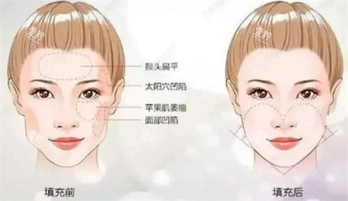 面颊填充术前后对比.jpg 面颊填充术前后对比.jpg