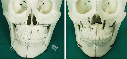 正颌手术手术原理展示图.jpg