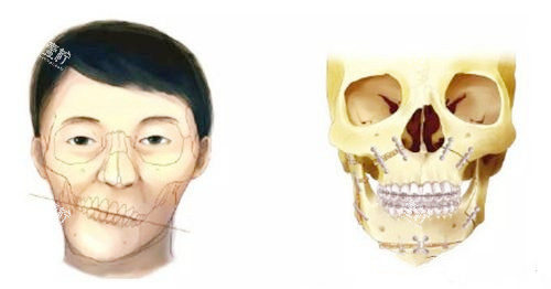 正颌手术对比图.jpg