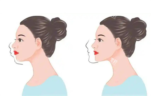 正颌矫正前后对比图.jpg
