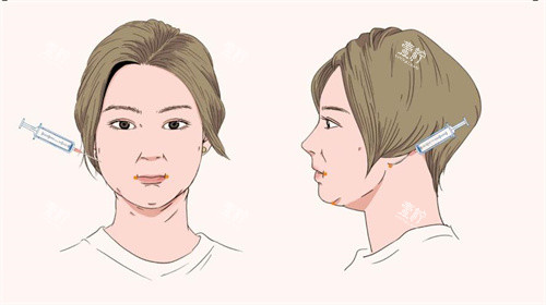 面部吸脂手术针管注射点位动画图.jpg