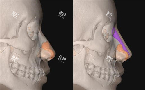 FITme3D鼻假体模拟隆鼻展示.jpg