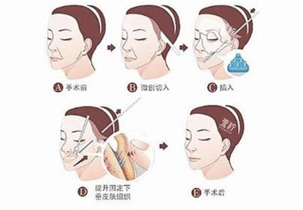 拉皮手术全过程.jpg 拉皮手术全过程.jpg