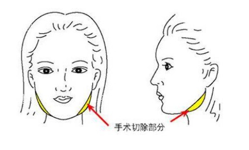 面部磨骨手术示意图.jpg