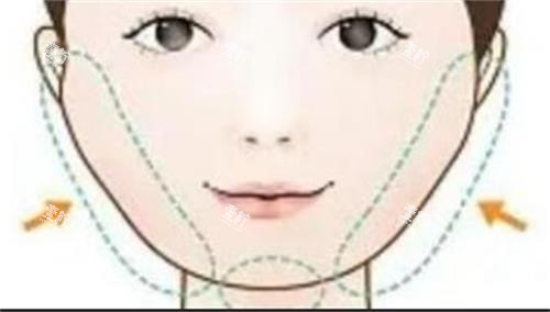 磨骨手术的部位.png