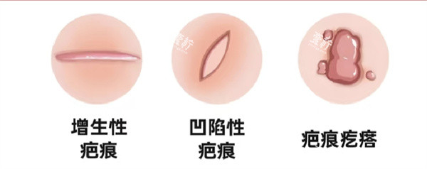 疤痕修复.jpg