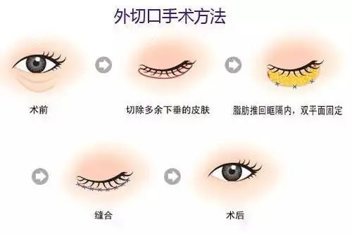 眼袋整形卡通示意图.jpg