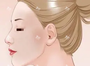 光子嫩肤示意图.png