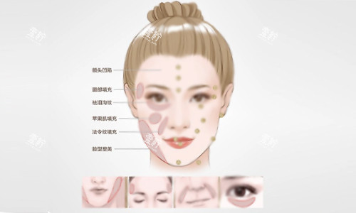 填充部位示意图.jpg