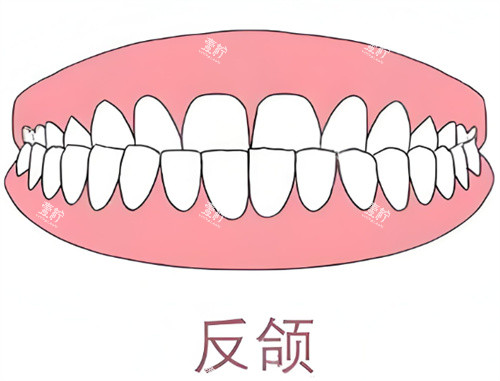 牙齿反颌卡通示意图.jpg 牙齿反颌卡通示意图.jpg