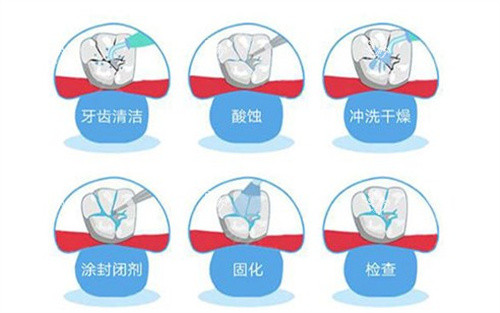窝沟封闭的过程.jpg 窝沟封闭的过程.jpg