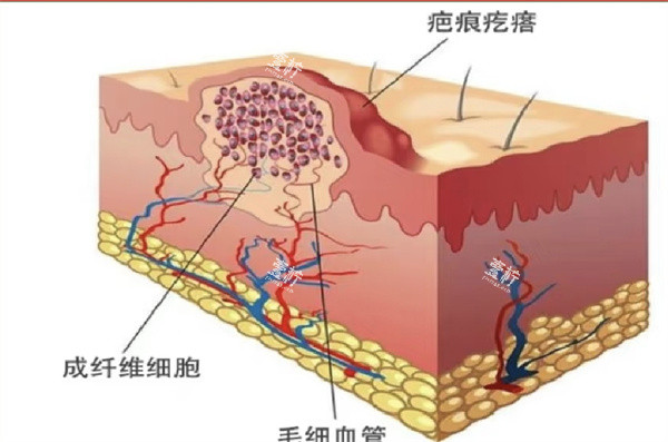 瘢痕.jpg