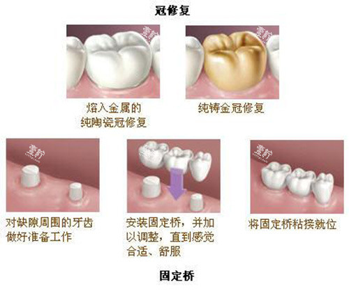 牙冠修复及固定桥展示过程.jpg