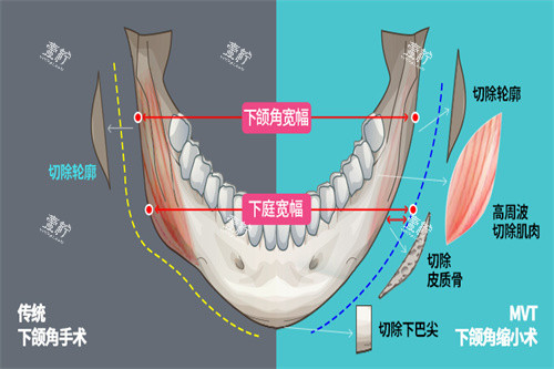 下颌角手术宣传图.jpg