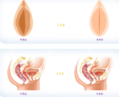 私密整形前后对比图.jpg 私密整形前后对比图.jpg