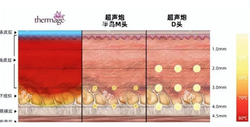 超声炮治疗深度对比.jpg