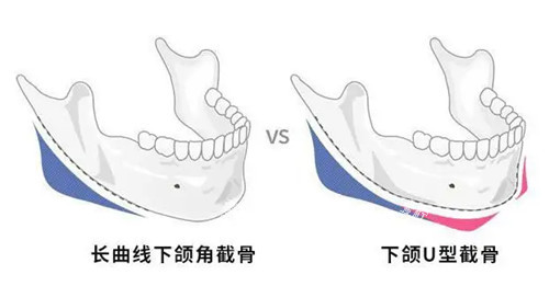下颌角截骨位置示意图.jpg
