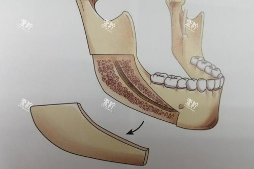 下颌角截骨卡通图.jpg