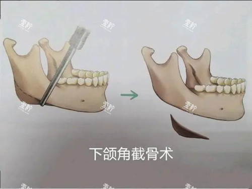 下颌角截骨术卡通示意图.jpg