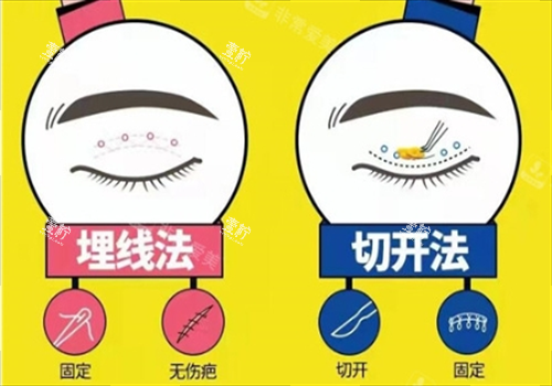双眼皮埋线和切开对比图.png