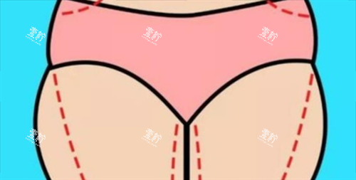 大腿吸脂术前画线展示图.png