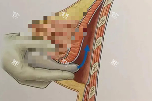 假体隆胸手术卡通示意图.jpg