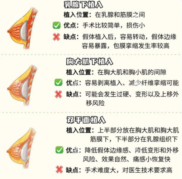 假体隆胸的不同植入位置图解.jpg