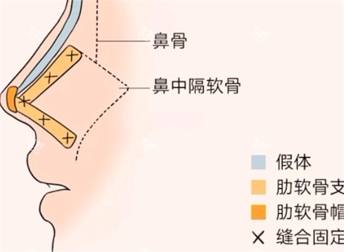 隆鼻形态.png