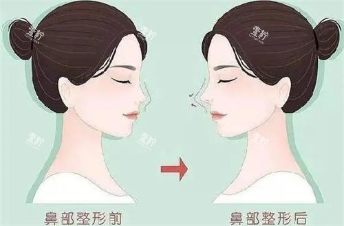 液态隆鼻前后的区别.png
