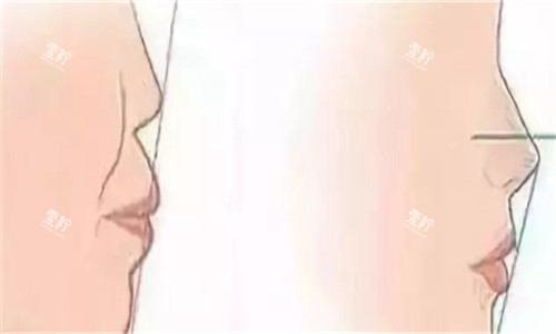 隆鼻前后侧面对比.jpg