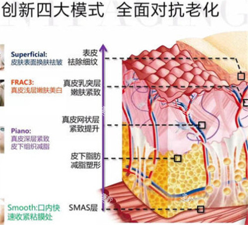fotona4d欧洲之星不同模式对应层次.jpg